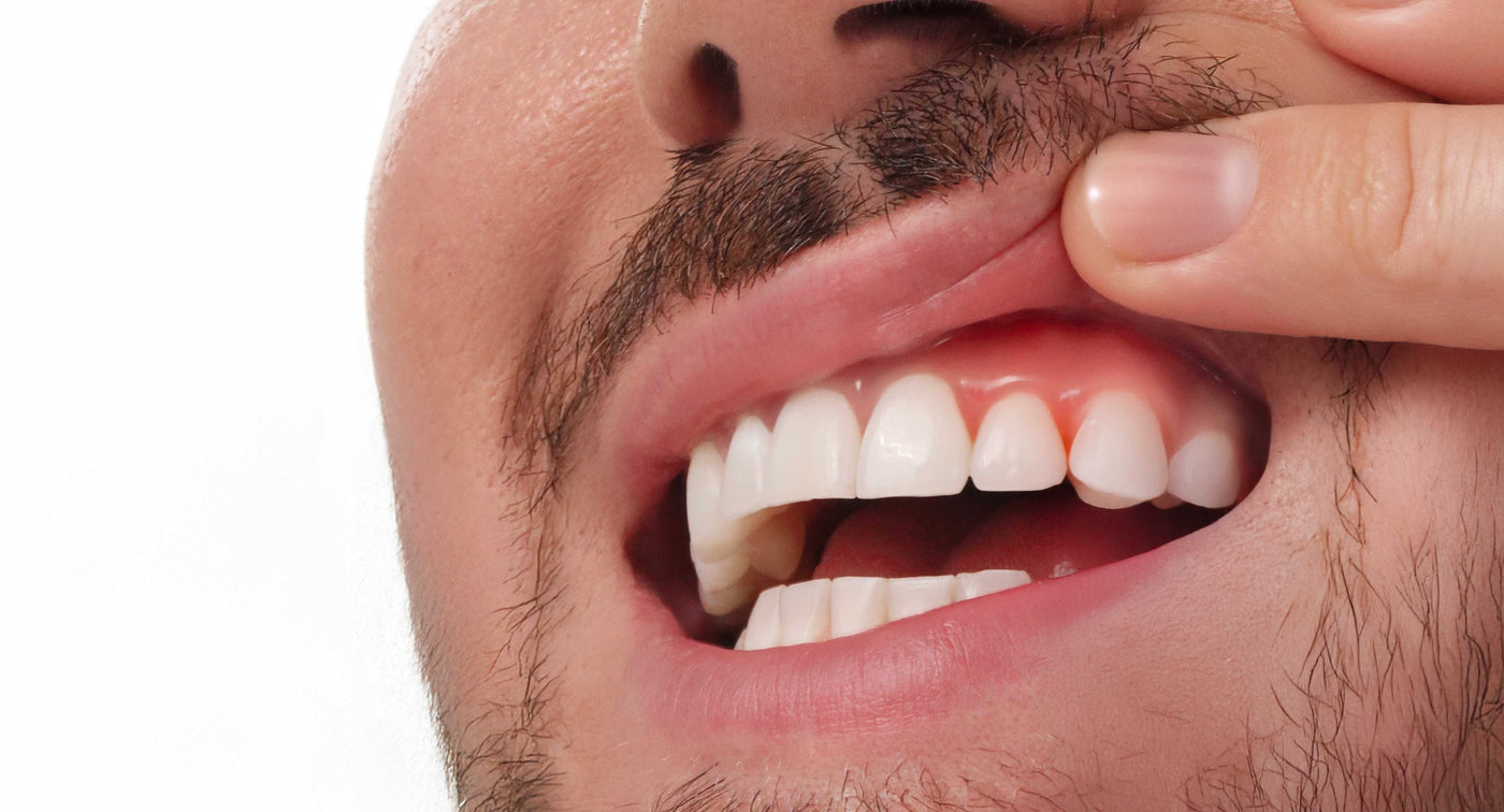 La gingivite : comprendre, prévenir, traiter naturellement